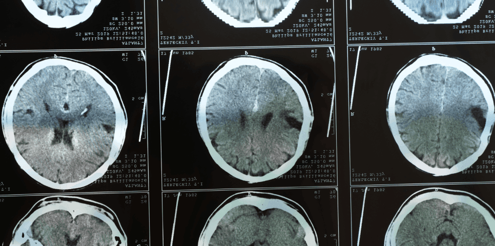 Traumatic Brain Injury Traumatic Brain Injury