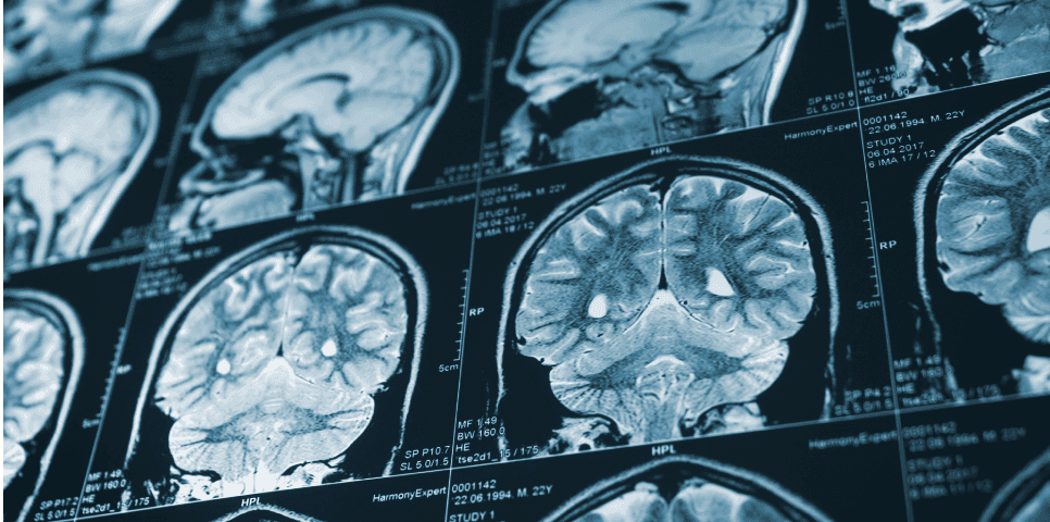 Brain Injury