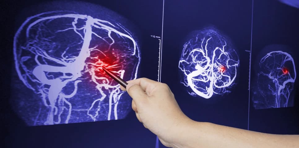 Traumatic Brain Injury Traumatic Brain Injury